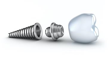Dental implant and screw
