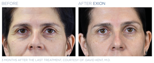 before and after exion treatment | exion treatment marysville wa