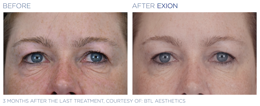exion before and after | facial aesthetics marysville wa