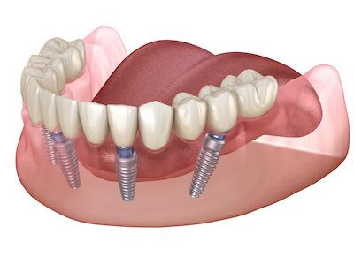 All-on-4 Implants in lower jaw | all on 4 implants marysville wa