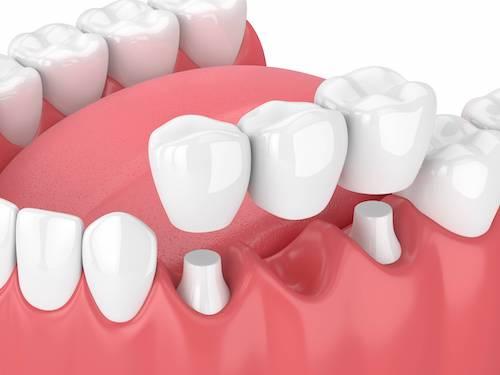 Diagram of dental bridges in Marysville WA