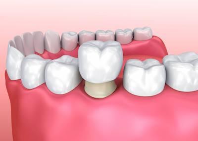 Diagram of a dental crown in Marysville WA