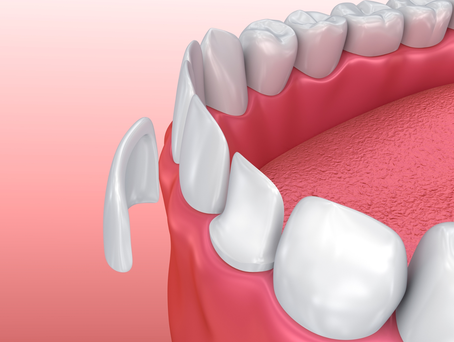 close up of porcelain veneer going on a single tooth
