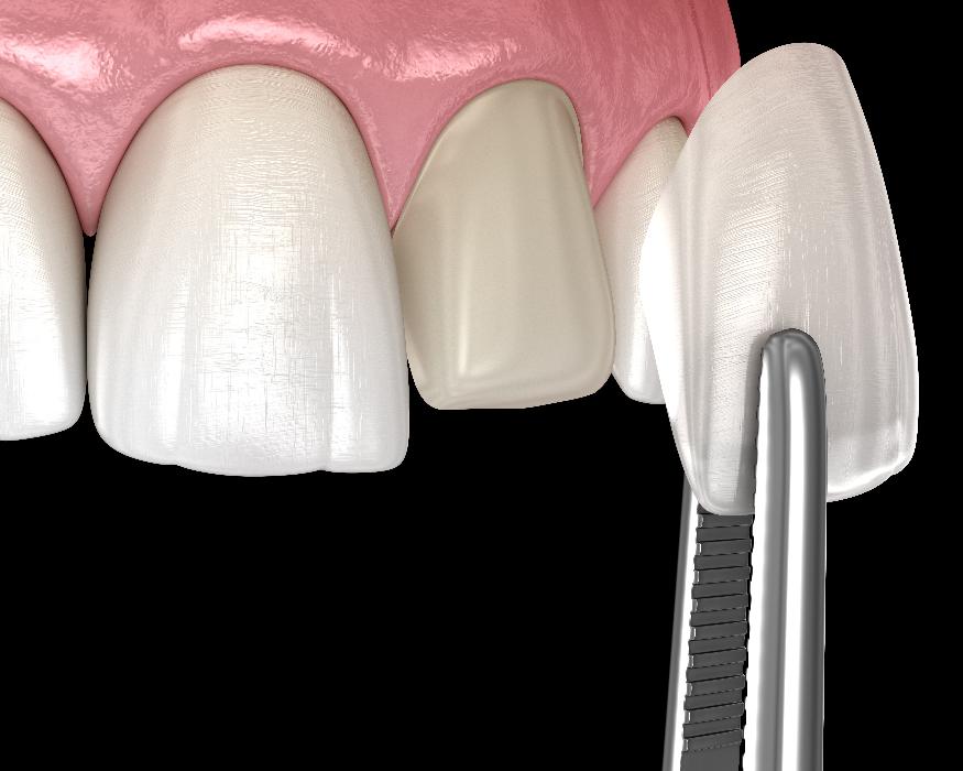 close up of veneer on tooth | veneers marysville wa