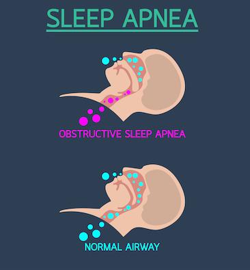 Sleep apnea diagram | sleep apnea marysville wa