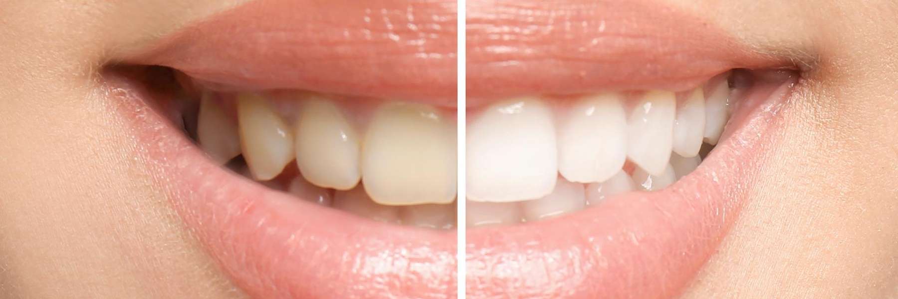 white smile before and after | marysville dentist