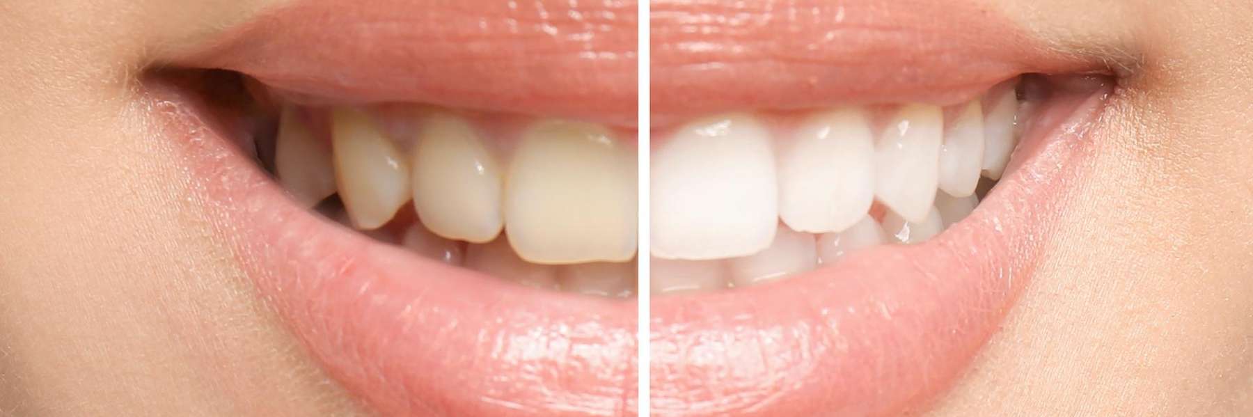 before and after teeth whitening | marysville dentist