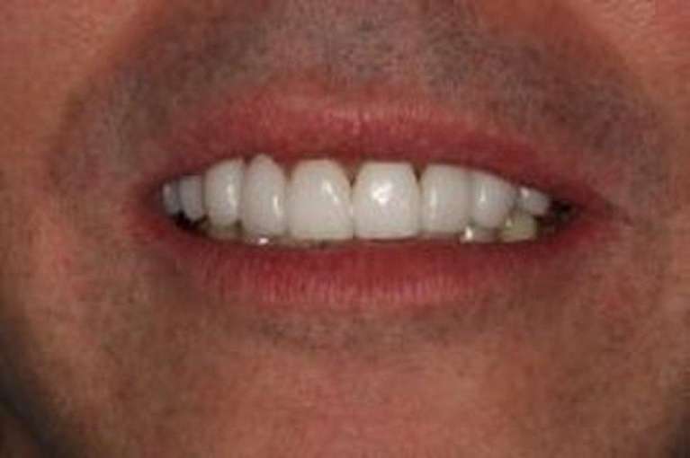 Patient-Smile-Before-and-After-Veneers-and-Crowns-After-Image