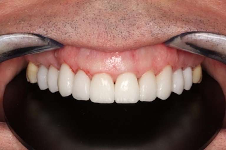Patient teeth after crowns and veneers