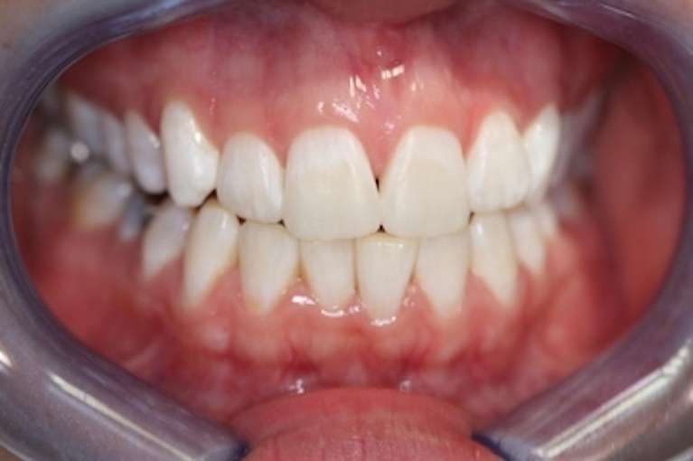 Patient after a deep teeth whitening in Marysville WA