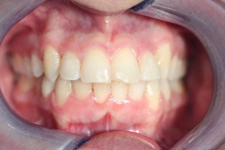 Patient after six month smile orthodontics in Marysville WA