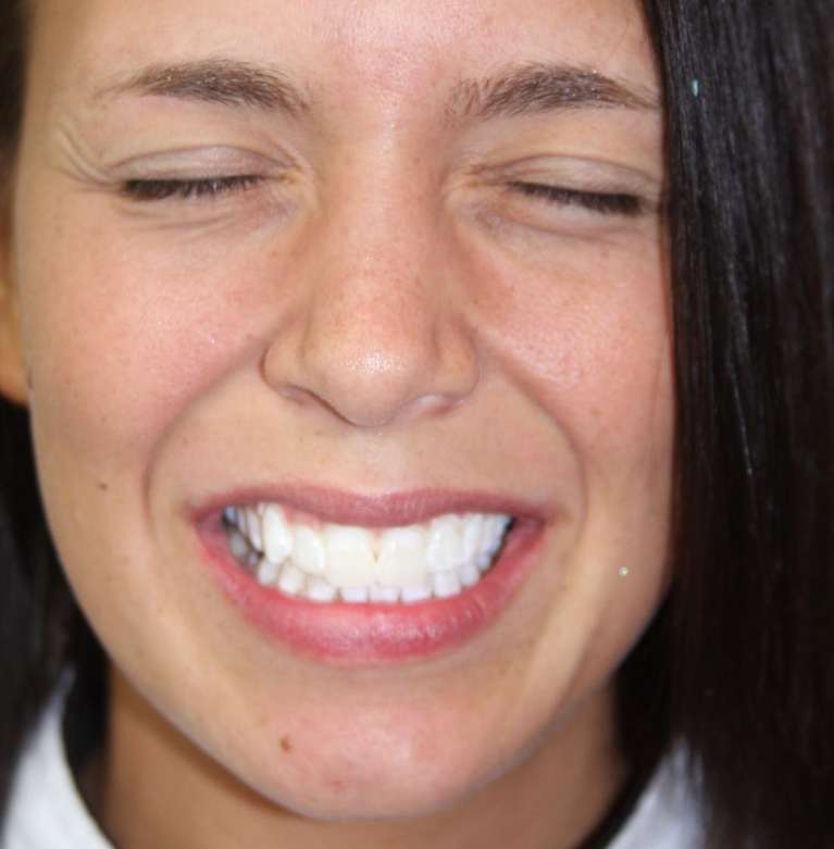 A woman after KoR teeth whitening in Marysville WA
