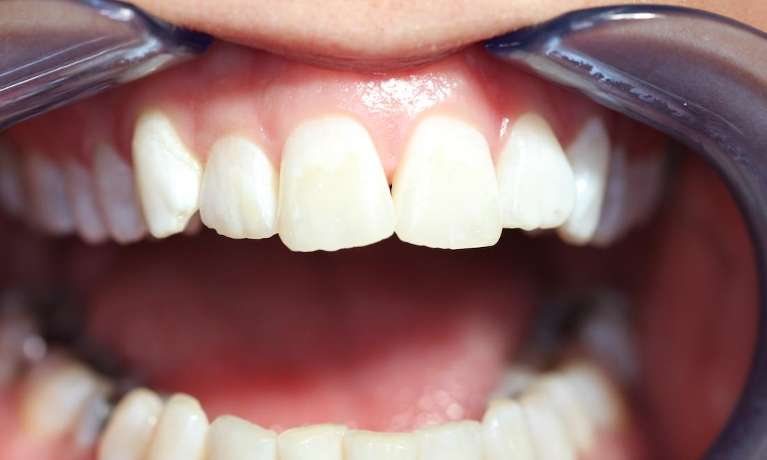 A patient after KoR teeth whitening | dentist marysville wa