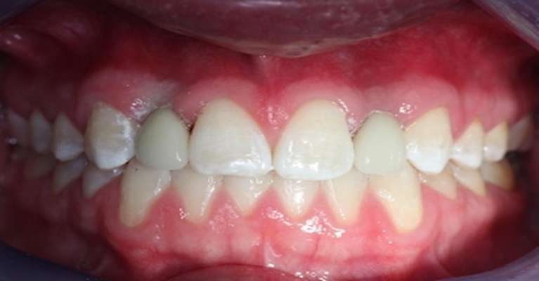 Congenitally-Missing-Lateral-Incisors-Replaced-with-Implants-and-Crowns-After-Image