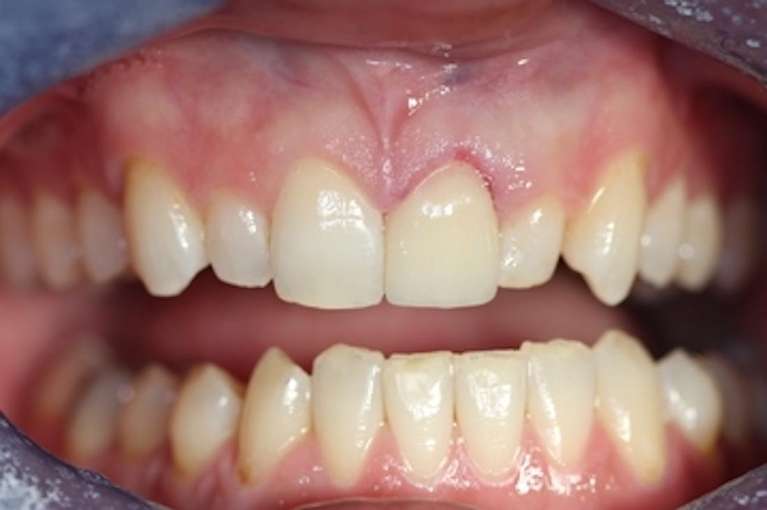 Patient-Smile-Before-and-After-Veneers-and-Crowns-Before-Image