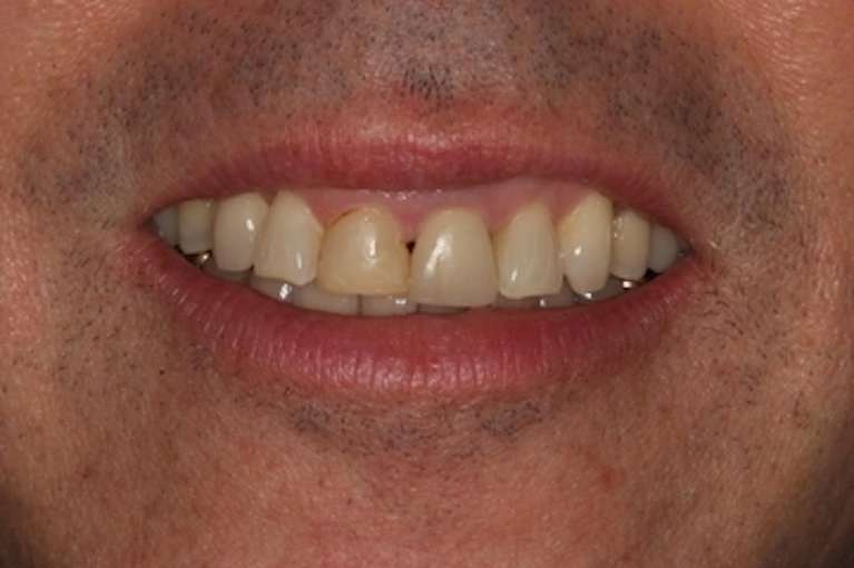 Patient teeth before crowns and veneers