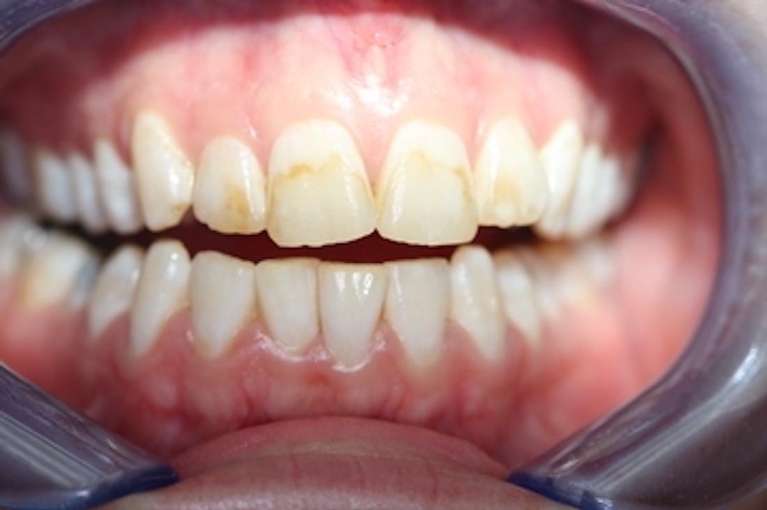 Patient before a deep teeth whitening in Marysville WA