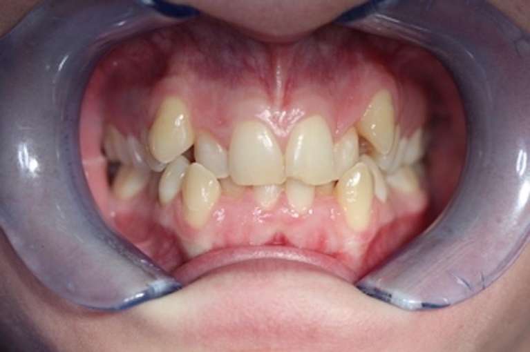 Patient before six month smile orthodontics in Marysville WA