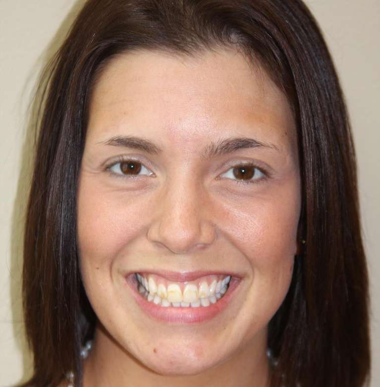 A woman before KoR teeth whitening in Marysville WA