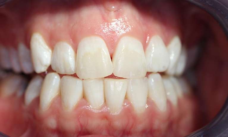 A patient before KoR teeth whitening | teeth whitening marysville wa