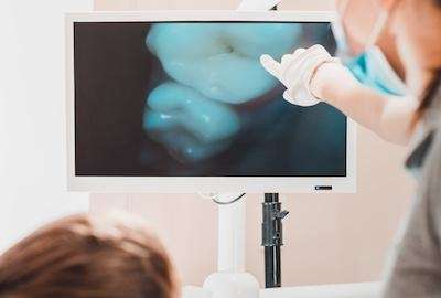Intraoral camera images | marysville dentist