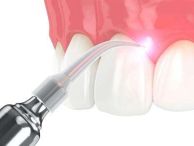 Diagram of laser dentistry in Marysville WA