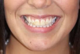 Blu Dental & Wellness stained teeth
