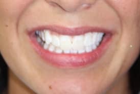 Blu Dental & Wellness new whiter smile